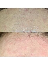 んまち/産毛の詰まり黒ずみも！