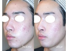 岩川治療院/ニキビ肌も改善！