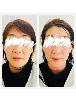 ヨサパーク マヒナ(YOSA PARK Mahina)/Before After