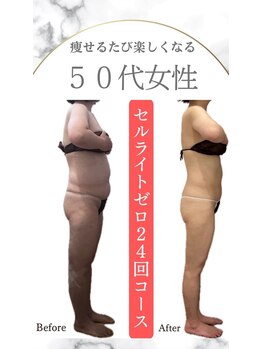 ムーン 高崎店(MOON)/セルゼロ痩身
