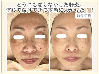 ポモナ 横浜馬車道店(Pomona)/シミとかんぱんにお悩みのお客様