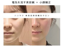 ハリサクの雰囲気(継続ケアでキュッと引き締まった小顔に♪)