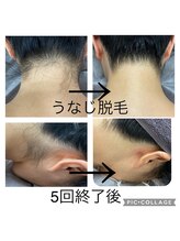 ボルベール(volver)/うなじ脱毛