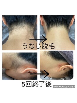 ボルベール(volver)/うなじ脱毛