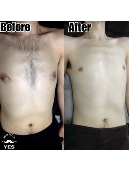 イエス 東京池袋店(YES)/胸毛脱毛