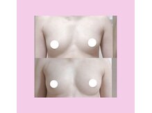 ミリミリ(mili mili)/バスト施術