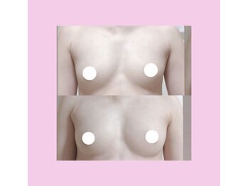 ミリミリ(mili mili)/バスト施術