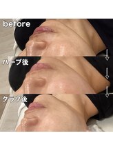 ランタン(Lantern)/究極の肌質改善コース