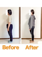 整体院ひなた 都城院/猫背反り腰と朝の腰痛が改善