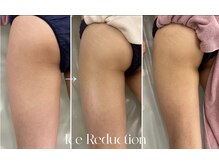 エステティックサロン フェアリー(ESTHETIC SALON FAIRLY)の雰囲気（有名モデルも御用達☆圧倒的！確実な結果◎【脂肪冷却マシン】）