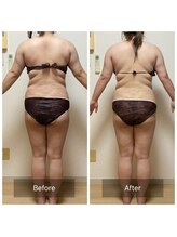 ヨサパーク ベア(YOSA PARK Beat)/30代女性 before after