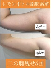 レシェルサロン(Lechelle Salon)/レモンボトル脂肪分解　二の腕