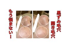 アールズ 南風原(R’s)/黒ずみ毛穴｜開き毛穴