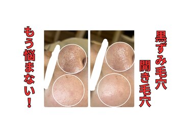 アールズ 南風原(R’s)/黒ずみ毛穴|開き毛穴