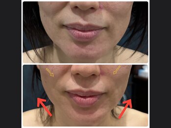 キュライム 熊本(CURAIM)/造顔πセラピー【40代女性】