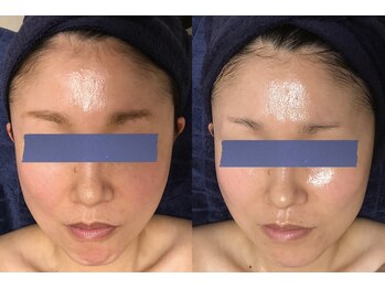 アブソリュートワン(absolute1)の写真/「限界肌にはコレ」レチノール進化系！何をしても改善しない肌に直球！肌質改善と理想の肌が叶う究極ケア。