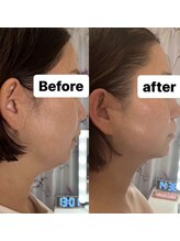 フェミニー(Feminy)/【小顔整顔リフト】顎下・頬肉