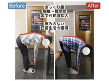 アンティオール 札幌店/60代女性　ぎっくり