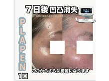 キキ(kiki)/白玉ピコジェットB/A