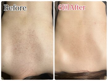 エミルカ 北谷店(EMILUCA)/背中　毛孔性苔癬