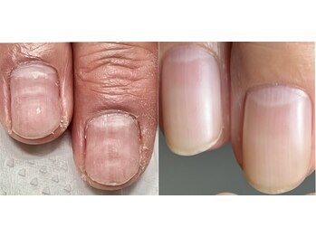 イズム(Izm)/上before/下after自爪風自爪育成