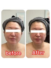 ルクール(Le Couer)/低周波リフト