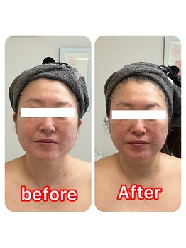 ルクール(Le Couer)/低周波リフト