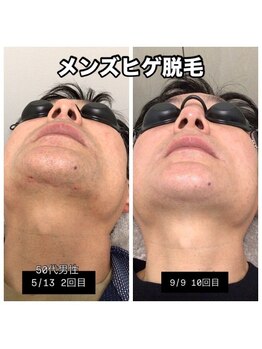 マリーローラン メンズルイズ(Marryrolan MensRuise)/メンズ脱毛【ヒゲ脱毛】経過