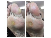 厚木 海老名 巻き爪矯正センター/事例【ドイツ式フットケア】