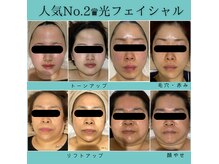 バブル(BUBRU)の雰囲気（毛穴/小顔/どんな肌悩みも改善♪１回でわかる効果★肌荒れにも♪）