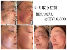 シンデレラ しみケア(Cinderella)