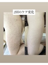 スキンプローズ(skinprose)/二の腕ハーブピーリング・ハード