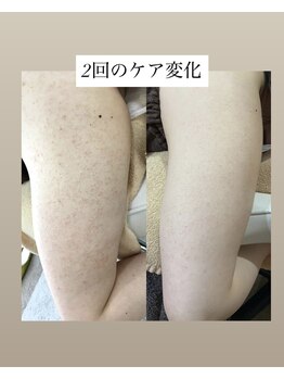 スキンプローズ(skinprose)/二の腕ハーブピーリング・ハード