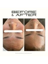 オフモード(OffMode)/打たないボトでシワ改善