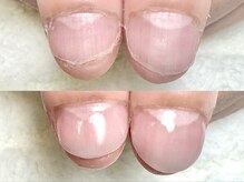 グラシナ なんば店/深爪/自爪育成/フィルイン