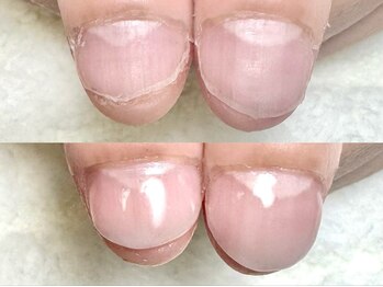 グラシナ なんば店/深爪/自爪育成/フィルイン