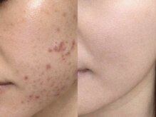 beauty salon LALA 大阪南森町｜ハーブピーリング・肌質改善・インディバの雰囲気（肌トラブル,跡ケアの短期集中改善ならお任せください♪）