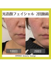 アマナ(AMANA)/ニキビ/たるみが気になる方へ