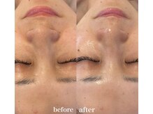 リーミー(Re:me)/ラミネーションピールコース