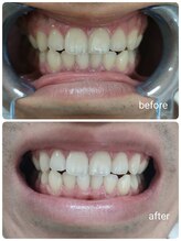 エクシア ホワイトニング 鶴岡店/ビフォーアフター