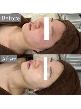 ホワイトアクア 鳳店(WHITE AQUA)/ララピール/大阪/鳳/毛穴/ツヤ肌