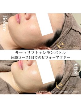 エスプリ 銀座店/小顔エステ銀座・レモンボトル