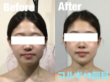 ビーキュート 学芸大学店(BE-CUTE)/歪み矯正18回施術　20代　