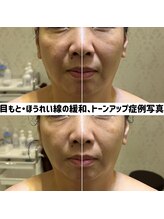 リジェ(Rege)/50代女性の方　施術