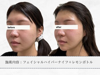 エメ 名古屋栄店(aimer)/レモンボトル<小顔・脂肪分解>