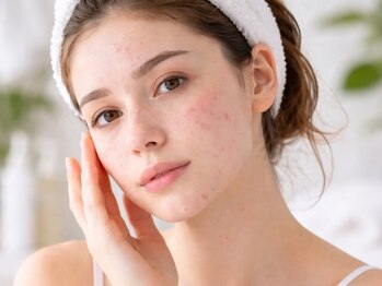 カプロ ボゥ(Capullo.Beau)の写真/『その肌悩み、諦めないで！』医療提携サロンだから出来る！根本肌質改善◆大人ニキビケアの特化サロン◎