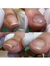 巻き爪補正店 越谷店/巻き爪補正