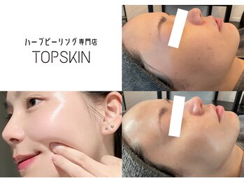 トップスキン 新宿(TOPSKIN)の写真/【経験豊富なプロが施術】30代40代以降の気になるシミやたるみを一気に改善！肌質改善専門の本格美肌ケア☆