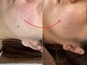 【55歳～のたるみ施術】迷ったらこのクーポン！たるみ引き締めリフトアップ！