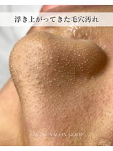 ゴールド 栄店(GOLD)/【毛穴洗浄パック後】